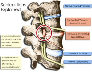 Subluxation